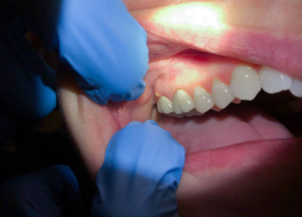 Best Knocked-Out Tooth Emergency  in Langley Park, MD